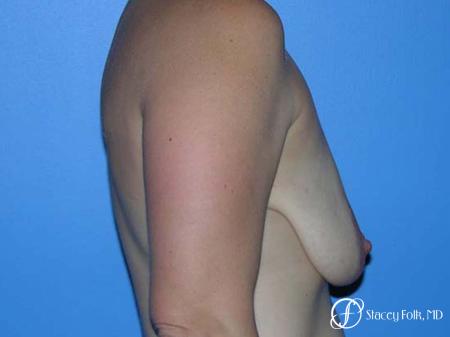 Denver Breast Lift - Mastopexy 7981 - Before and After Image 3
