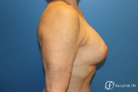 Denver Breast Revision 7990 - After Image 4