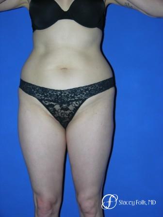 Denver Liposuction 961 - Before Image 1