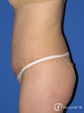 Denver Tummy Tuck - Abdominoplasty 10351 - After Image 2