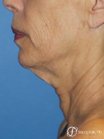 Facelift, Fat Transfer, Laser - Before Image 1