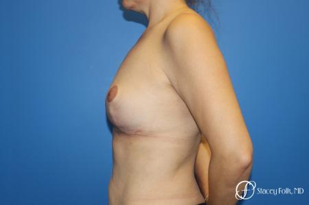 Fat Transfer Breast Lift (Mastopexy) - After Image 3