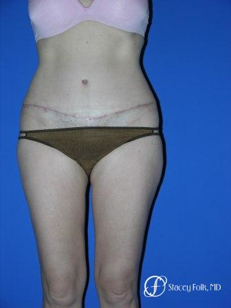 Denver Tummy Tuck 34 - After Image 1