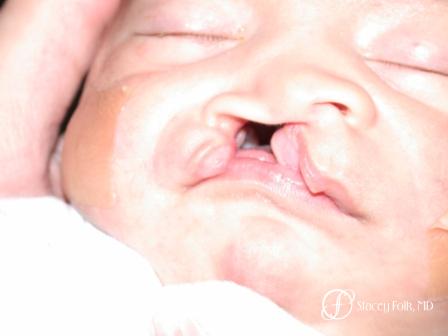 Denver Cleft Lip and Palate Repair - Before