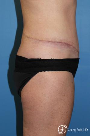 Denver Tummy Tuck 4817 - After Image 3