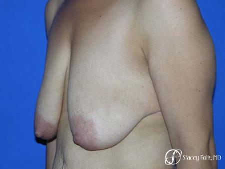 Denver Breast Lift - Mastopexy 7982 - Before Image 2