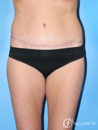 Denver Tummy Tuck - Abdominoplasty 7713 - After Image 1