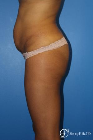 Tummy Tuck (Abdominoplasty) - Before and After Image 3