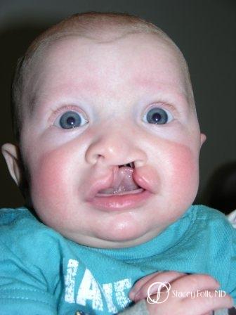 Denver Cleft Lip and Palate Repair 964 - Before Image 1
