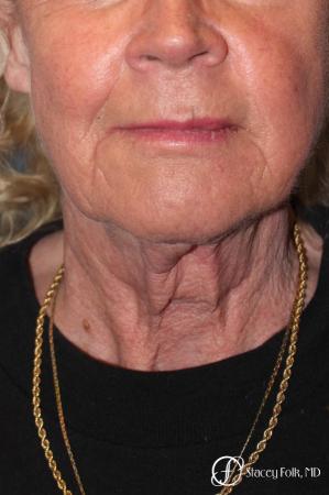 Denver Facial Rejuvenation Face lift, Fat Injections, and Laser Resurfacing 7131 - Before Image 3
