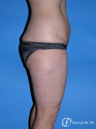 Denver Body Lift Belt lipectomy & liposuction 5264 - Before and After Image 3