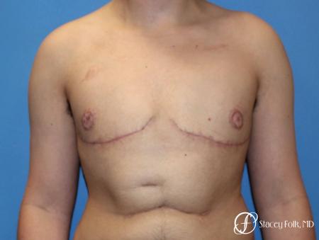 Denver Female to Male Top Surgery 5257 - After Image 1