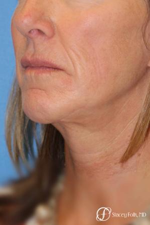 Denver Facial Rejuvenation Face lift, Fat Injections, and Laser Resurfacing 7132 - After Image 2