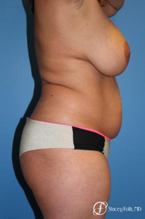 Denver Mommy Makeover 10298 - Before and After Image 3