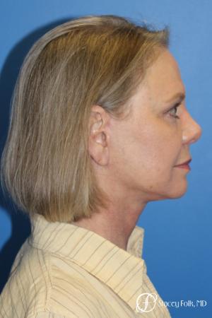Facial Rejuvenation: Patient 1 - After Image 3