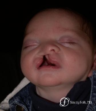 Denver Cleft Lip and Palate Repair 965 - Before Image 1