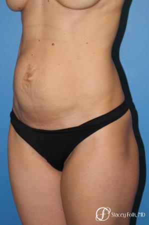 Denver Tummy Tuck (Abdominoplasty) 11239 - Before Image 2