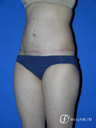 Denver Tummy Tuck 35 - After Image 2