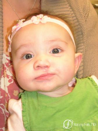 Denver Cleft Lip and Palate Repair 4776 - After Image 1