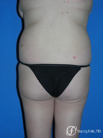 Denver Liposuction 3527 - Before and After Image 2