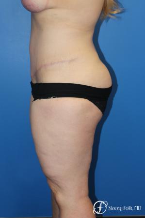 Tummy Tuck (Abdominoplasty) - After Image 3