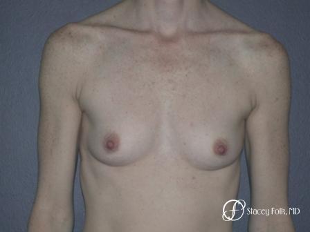 Denver Breast Augmentation 12 - Before Image 1