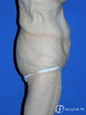 Denver Body Lift 5299 - Before and After Image 3