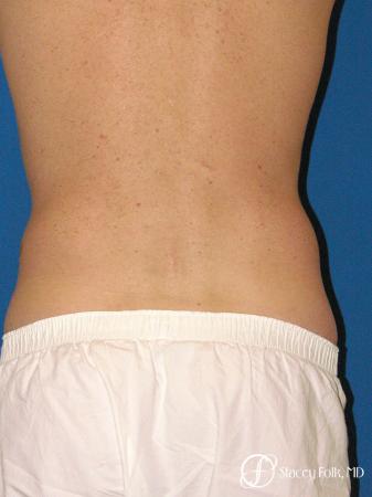 Denver Coolsculpting 5970 - After Image 2