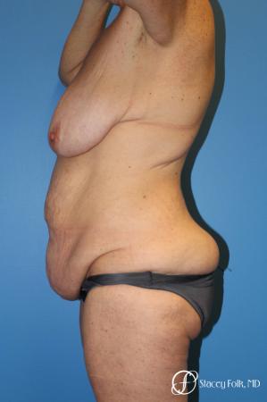 Denver Mommy Makeover Belt lipectomy, liposuction, mastopexy 5938 - Before and After Image 3