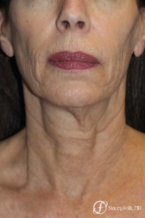 Facelift, Fat Transfer, Laser - Before and After Image 2