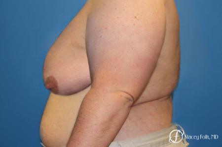Denver Female to male top surgery 5258 - Before and After Image 2