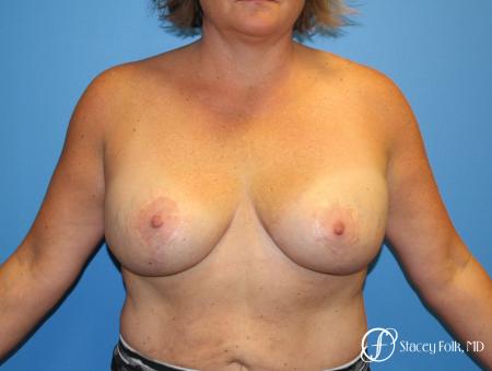 Breast Revision - Removal of Implant, Fat Transfer, Breast Lift (Mastopexy) - Before Image 1