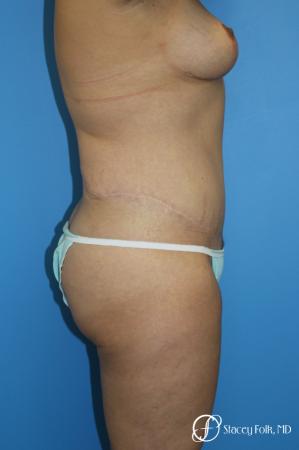 Denver Mommy makeover, breast reduction, abdominoplasty and liposuction 5353 - After Image 3