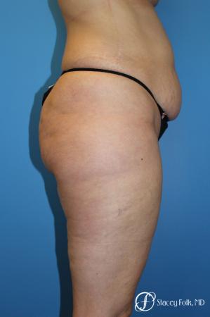 Tummy Tuck - Abdominoplasty - Before and After Image 3