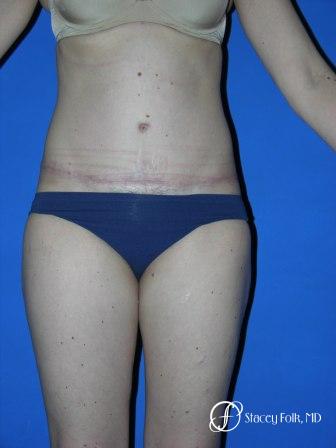 Denver Tummy Tuck 35 - After Image 1