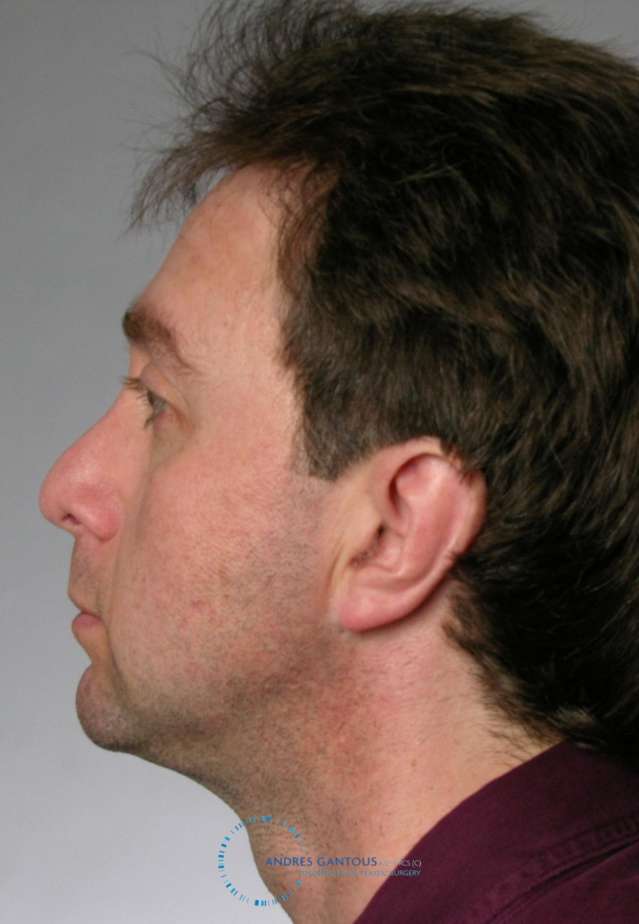 Revision Rhinoplasty: Patient 20 - Before and After 4