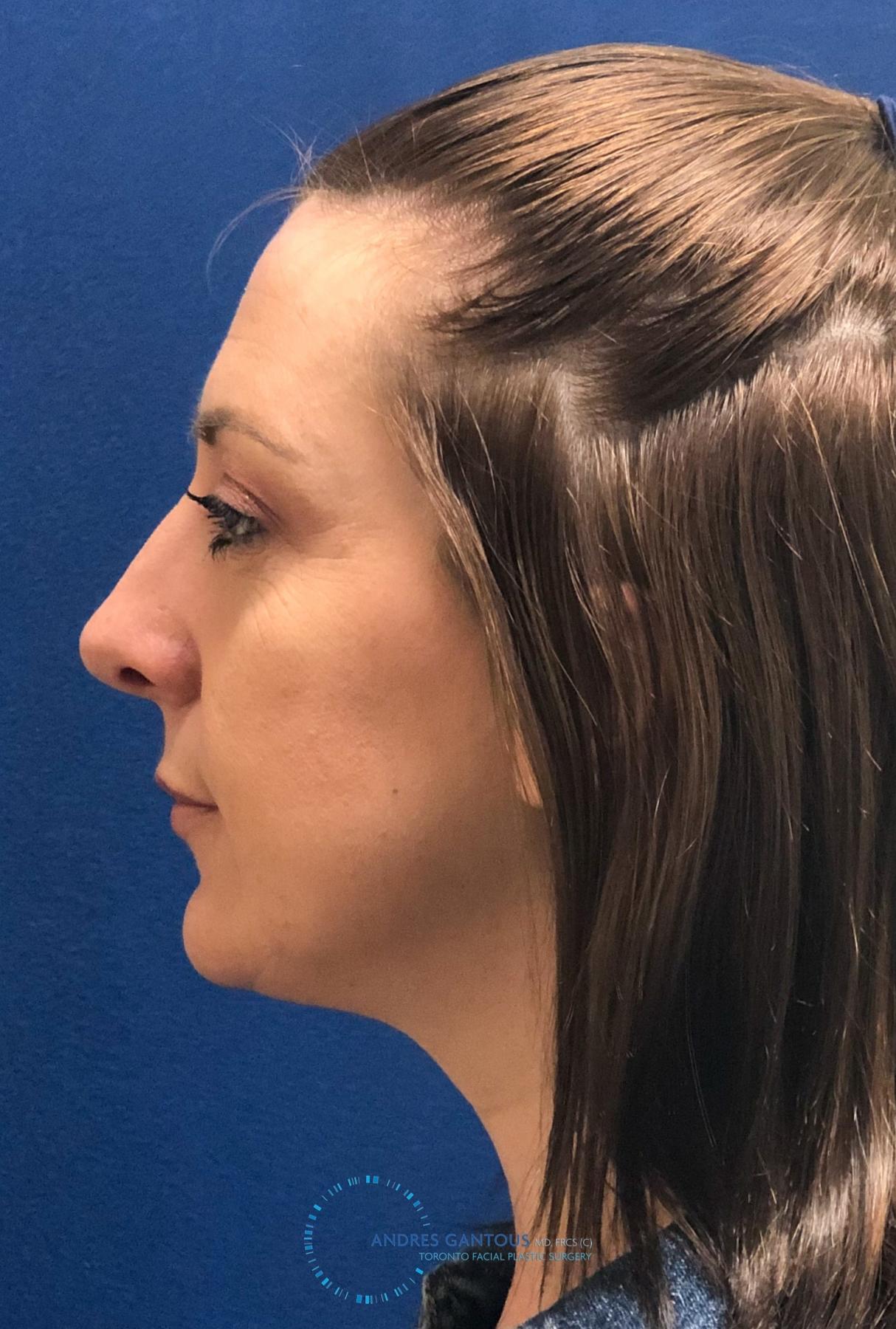 Rhinoplasty: Patient 25 - Before and After 6
