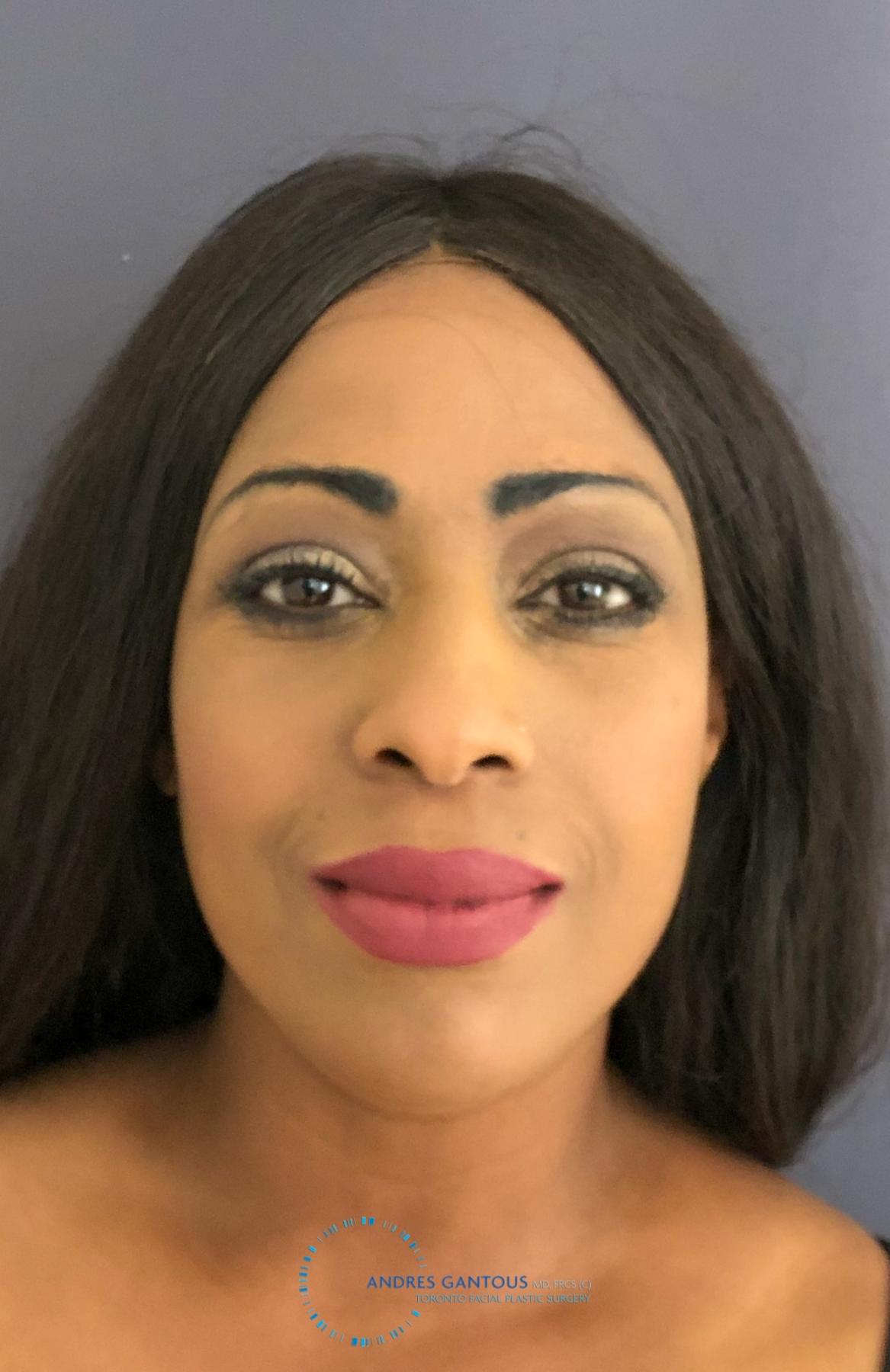 Rhinoplasty: Patient 64 - Before 