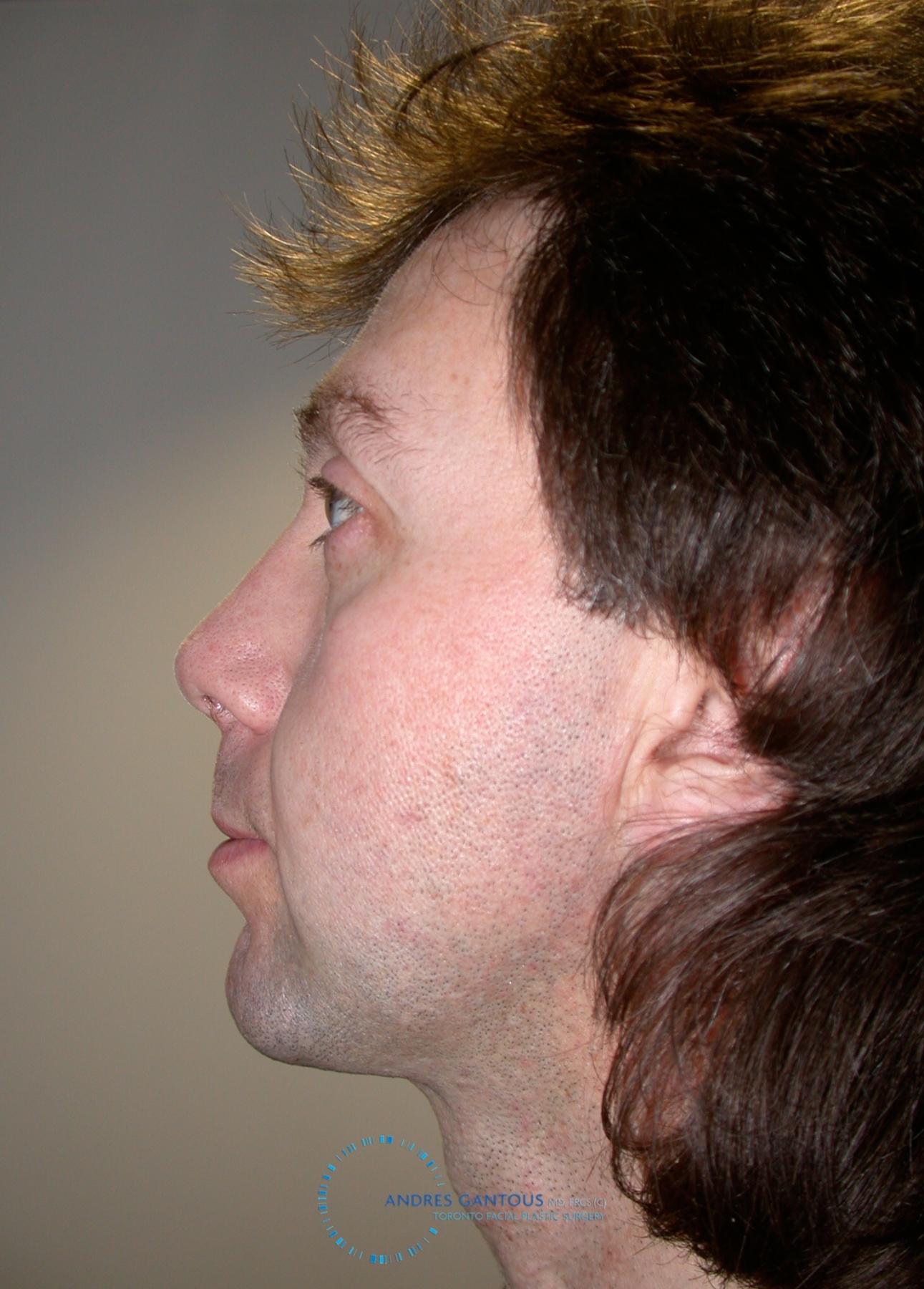 Revision Rhinoplasty: Patient 20 - After 4