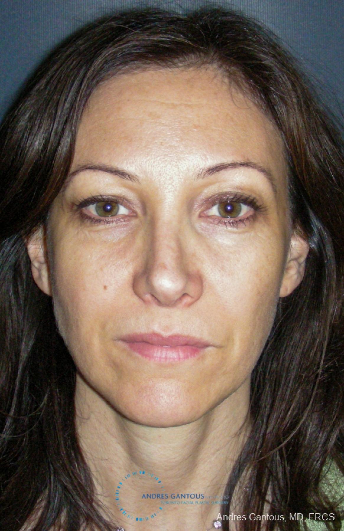 Revision Rhinoplasty: Patient 14 - After 