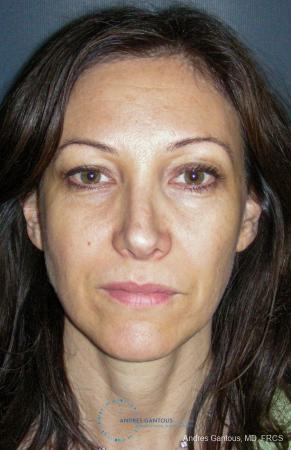 Revision Rhinoplasty: Patient 14 - After