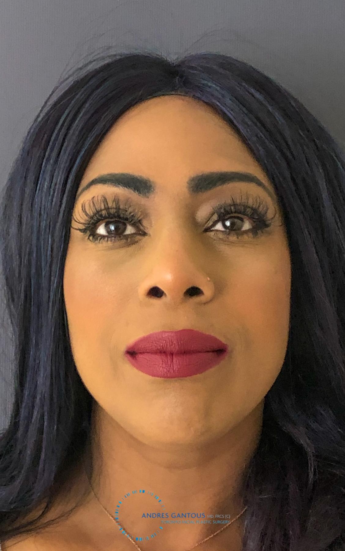 Rhinoplasty: Patient 64 - After 