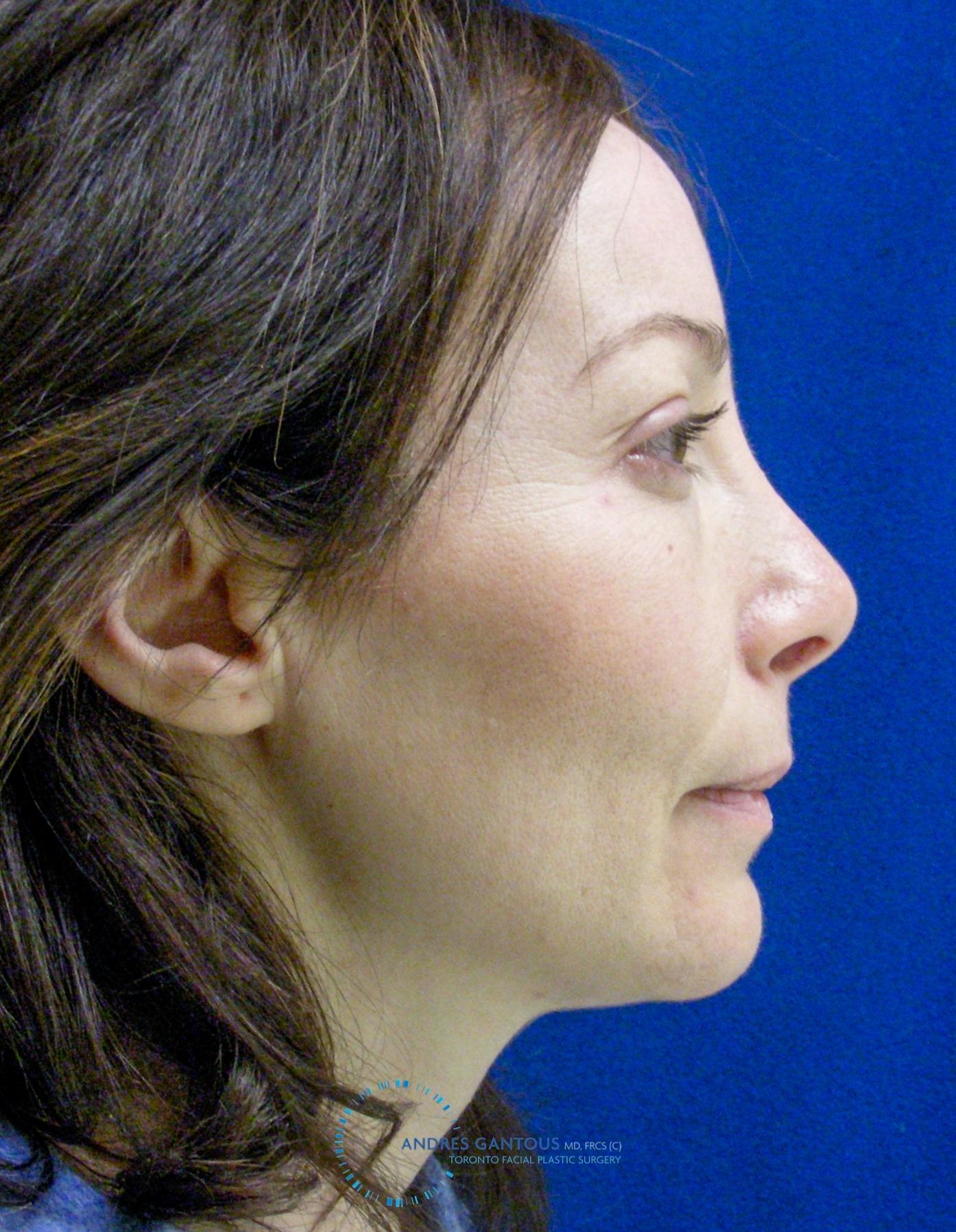 Revision Rhinoplasty: Patient 2 - After 4