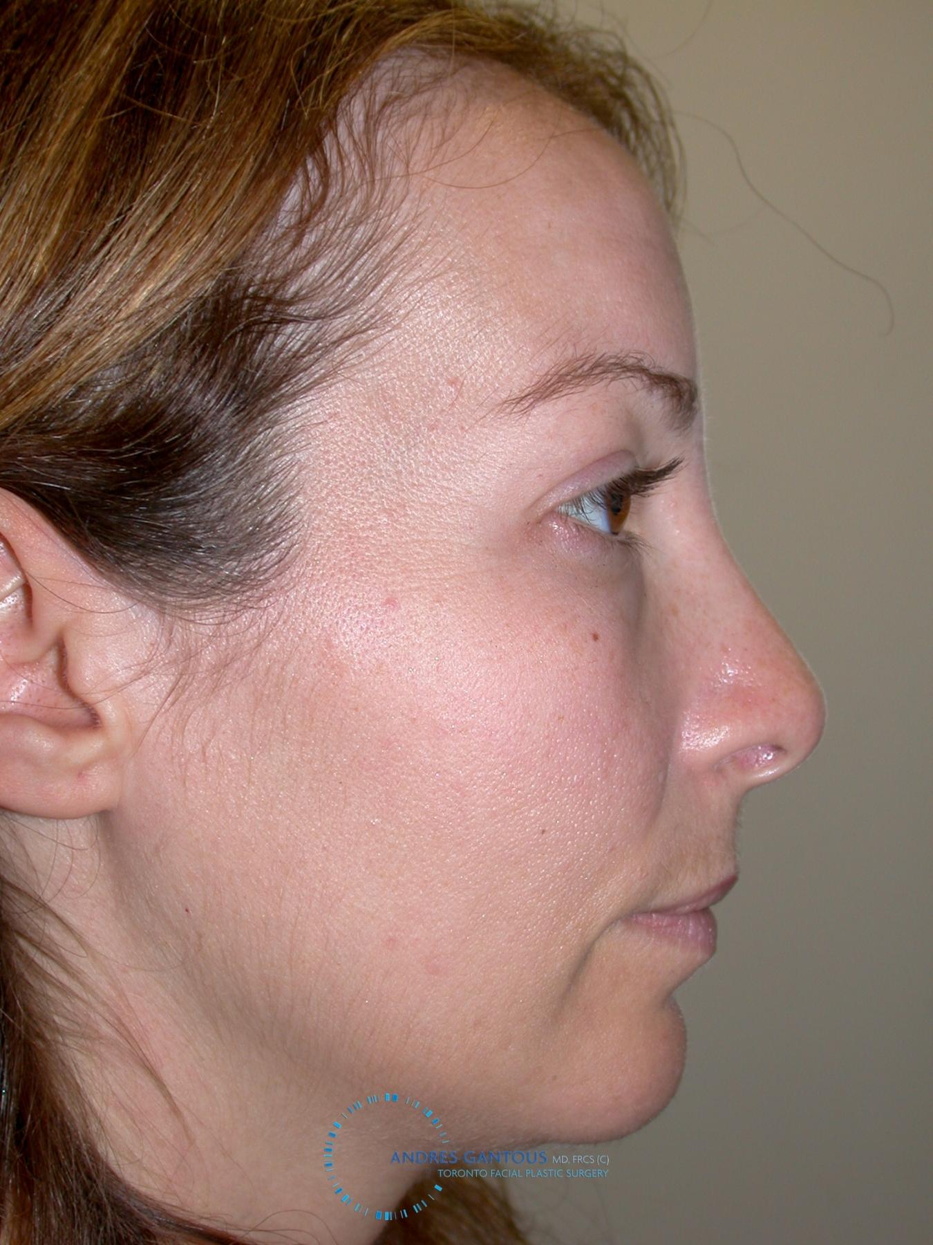 Revision Rhinoplasty: Patient 2 - Before 4