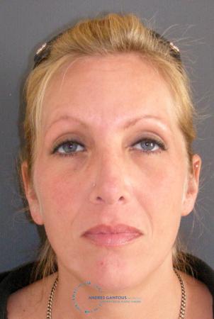Revision Rhinoplasty: Patient 16 - After