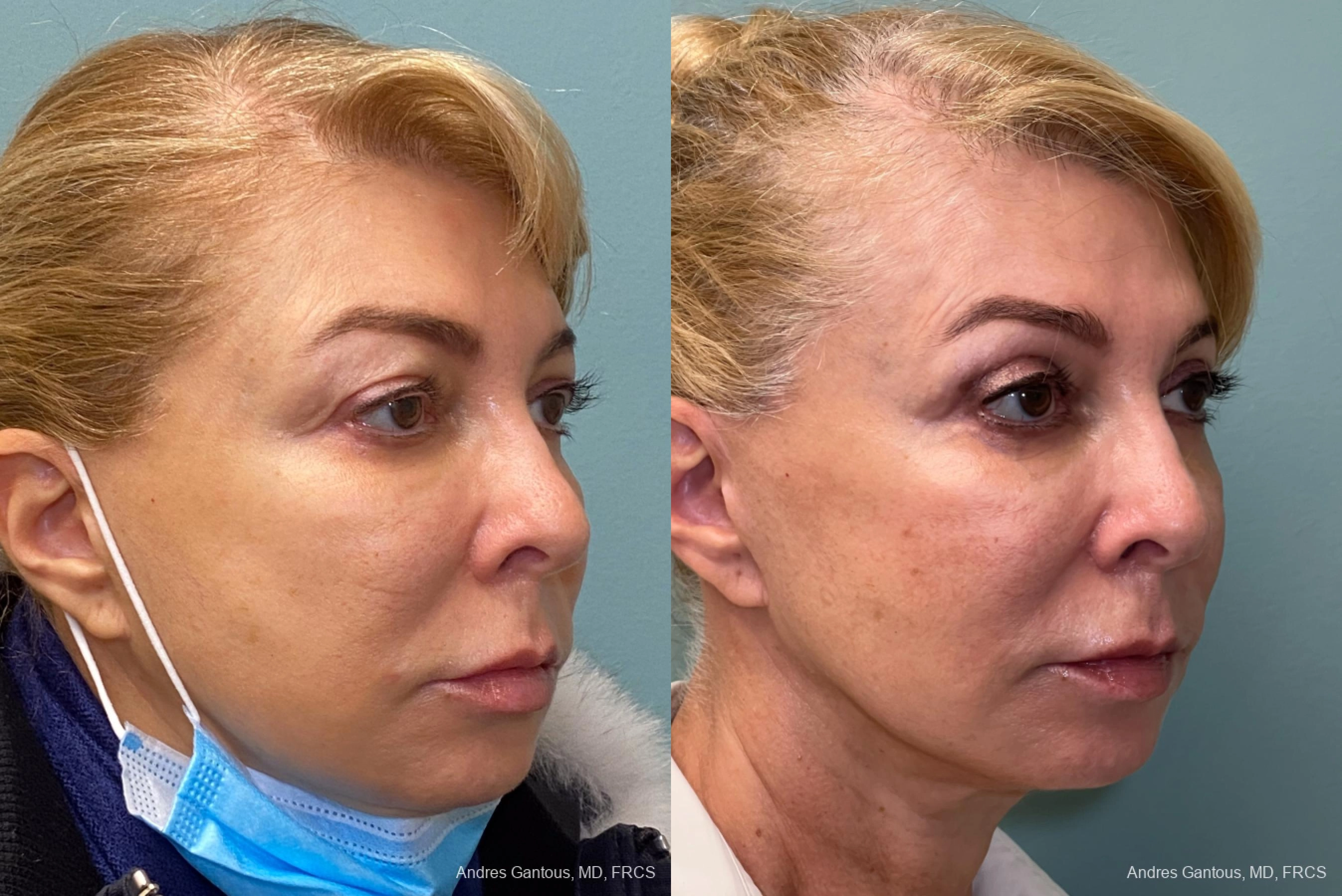 Blepharoplasty - Thumbnail 2