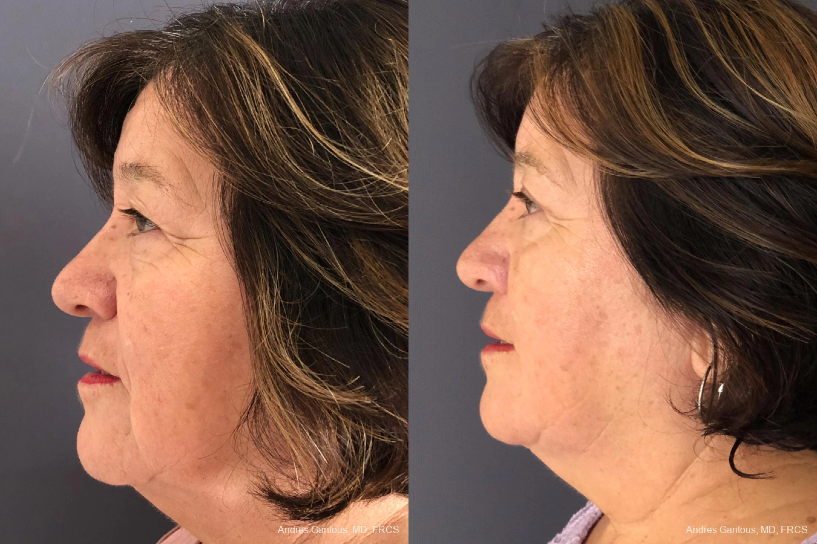 Blepharoplasty - Thumbnail 3