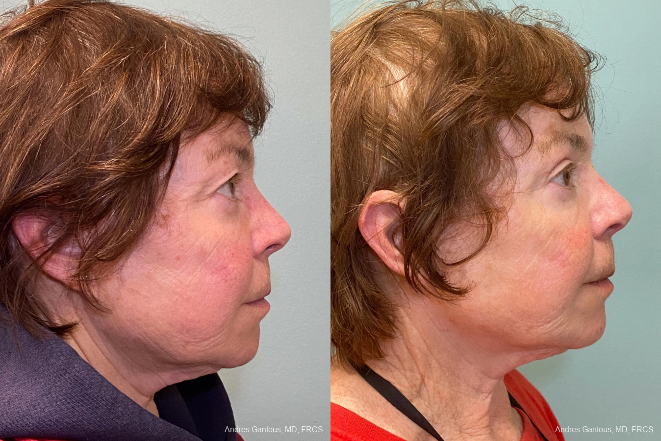 Blepharoplasty - Thumbnail 3