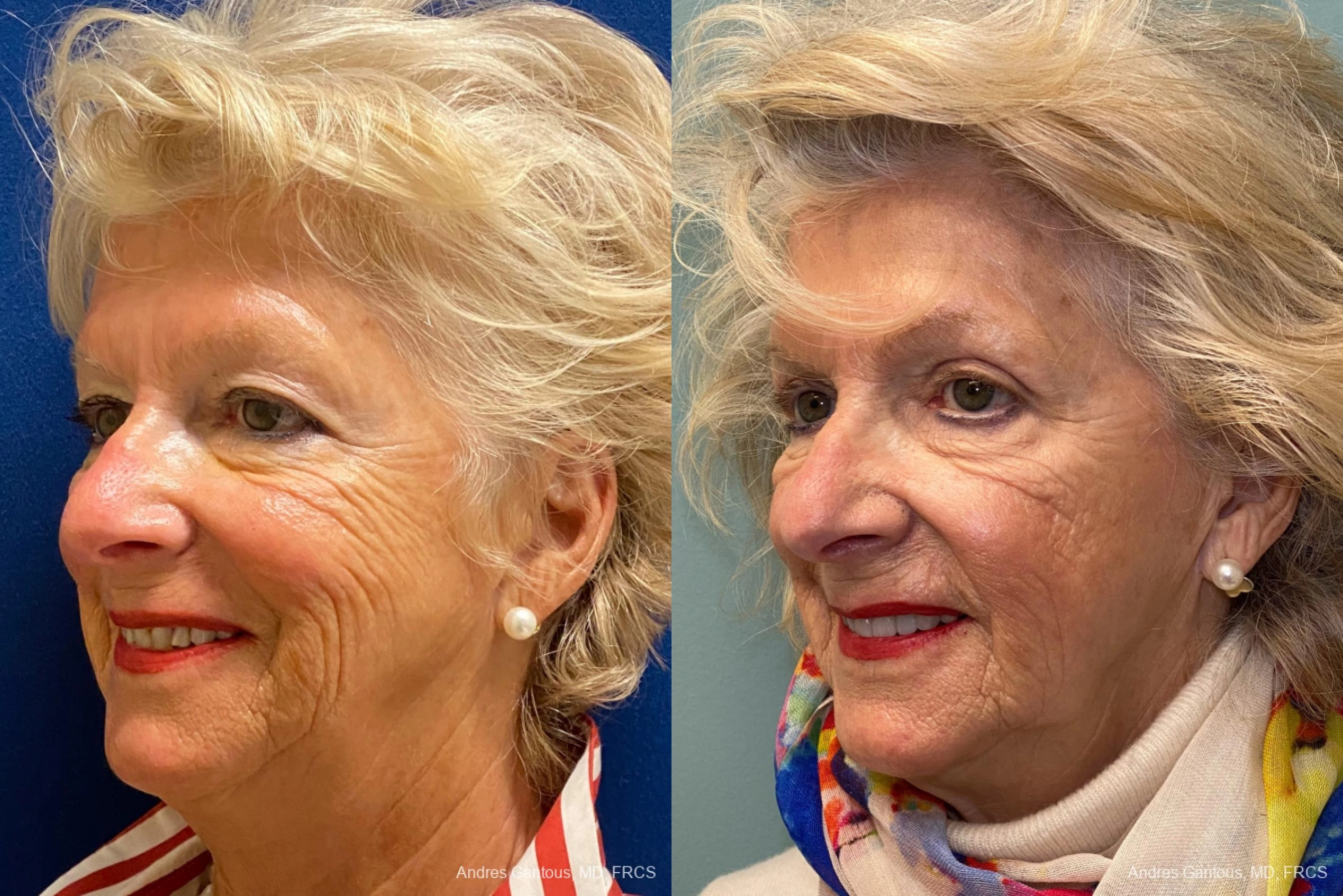 Blepharoplasty - Thumbnail 4