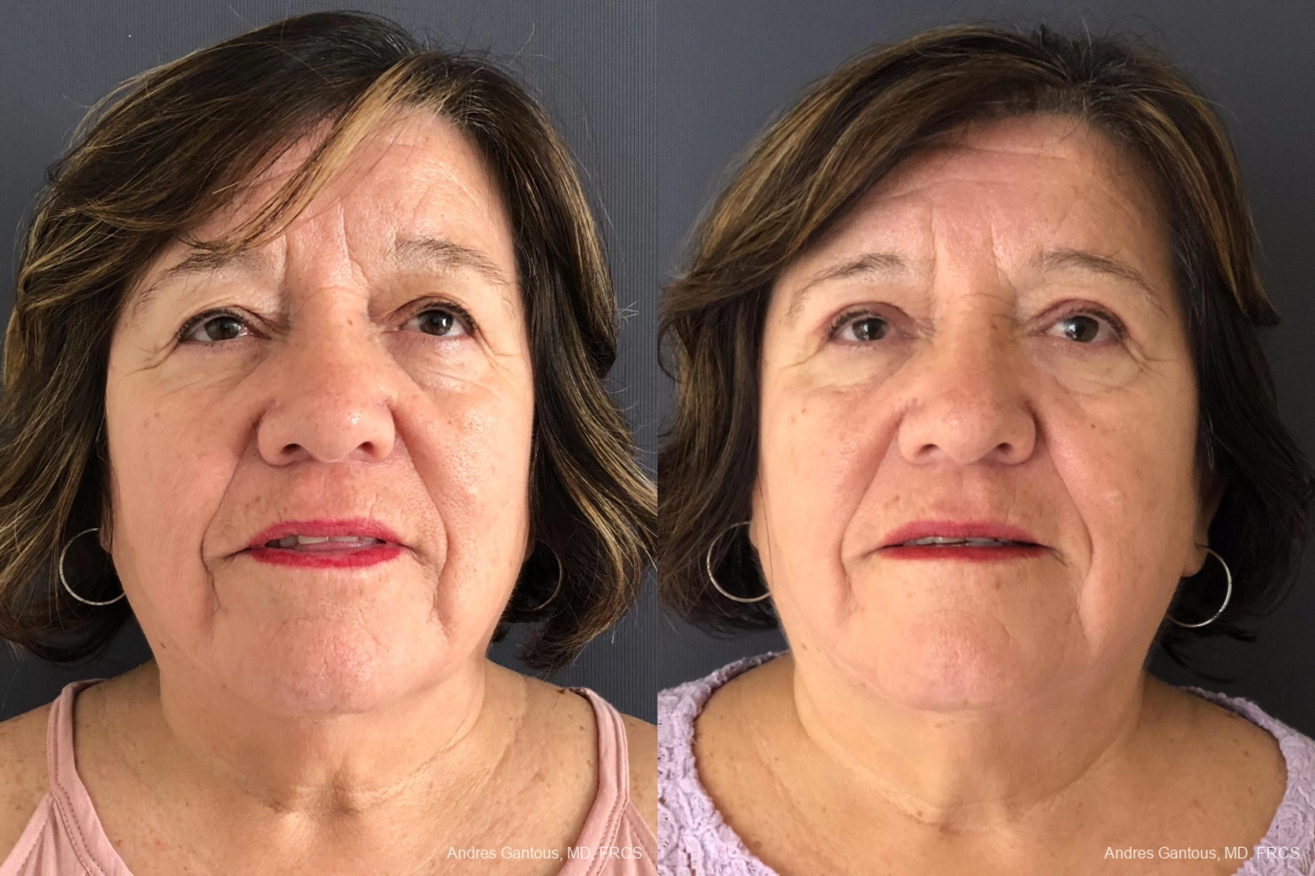 Face Procedures - Case 11758
